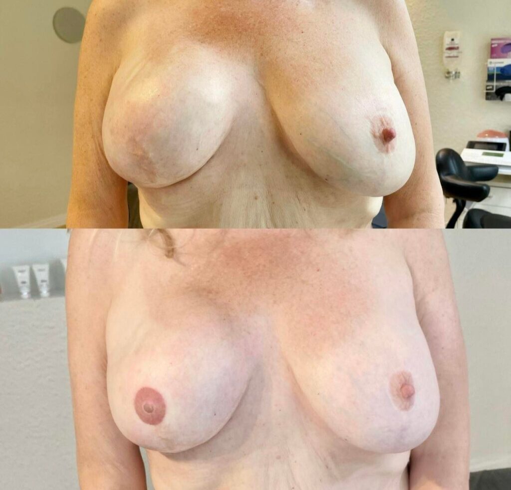 AREOLA PMU